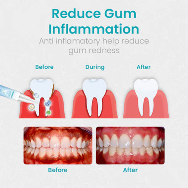 🔥Last Day 69% OFF-SEURICO™ Gum Shield Therapy Gel