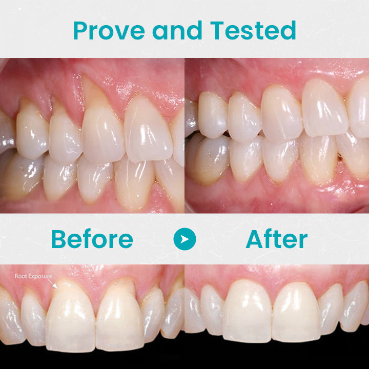 🔥Last Day 69% OFF-SEURICO™ Gum Shield Therapy Gel