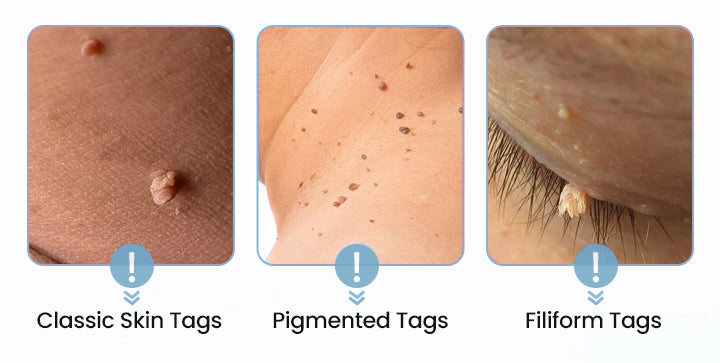 ODALIT™ Painless Nano Wart Removal Patch